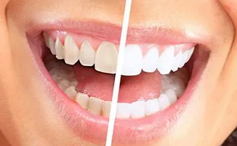 牙齿美白多少钱?一篇文章带你了解美白牙齿的各种方式