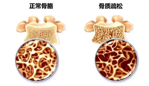 天天喝牛奶得骨质疏松？哪些维生素能够促进钙被人体吸收？