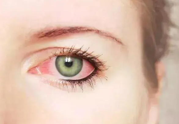 秋季眼部皮肤过敏症状有哪些?秋季眼部皮肤过敏涂什么好?