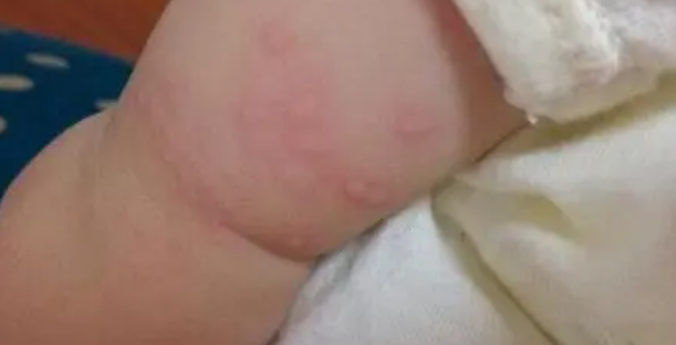 宝宝荨麻疹怎么治疗（宝宝荨麻疹严重吗该怎么应对）