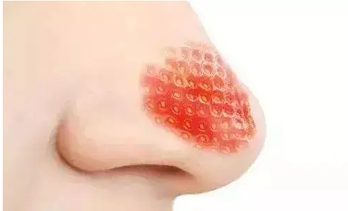 草莓鼻的错误处理方法有哪些(处理草莓鼻的误区)