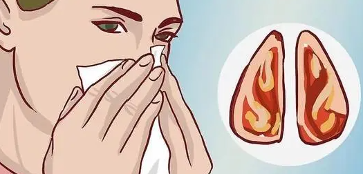 鼻炎用什么药效果最好（季节性过敏性鼻炎用什么药效果最好）