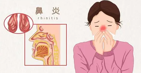 鼻炎是什么原因引起的（鼻炎是怎么回事,病根在哪里）