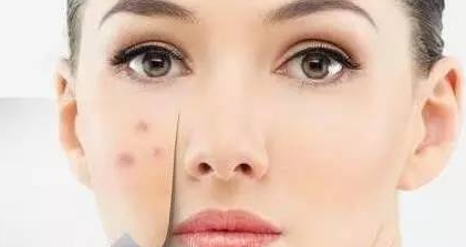 缺锌脸上会长痘吗,脸上长痘是缺锌引起的吗