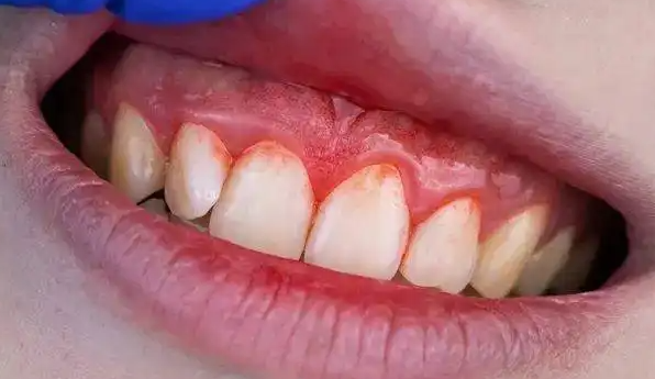 牙龈流血嘴巴臭是怎么回事（牙龈流血怎么止血才最有效果）