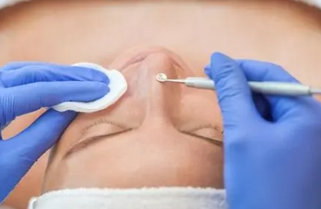 针清完痘痘红肿怎么护理(为啥针清完痘痘会变得又红又肿)