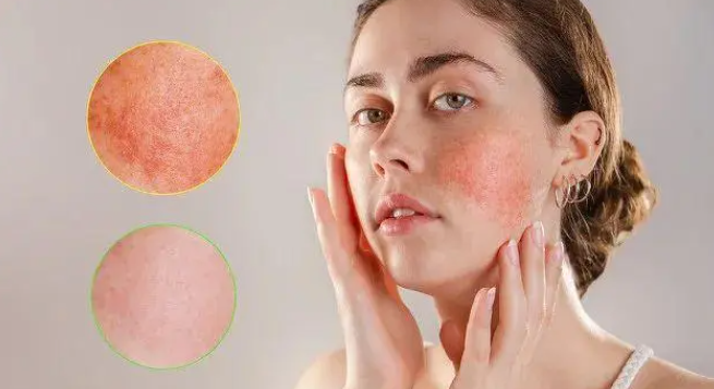 秋冬敏感性皮肤有什么表现(导致敏感性皮肤形成的原因是啥)