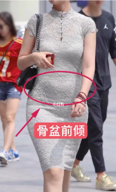 小腹突起就是骨盆前倾吗(骨盆前倾如何在家矫正)
