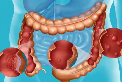 如何预防肠息肉再长出来(预防肠息肉超全食谱2022)