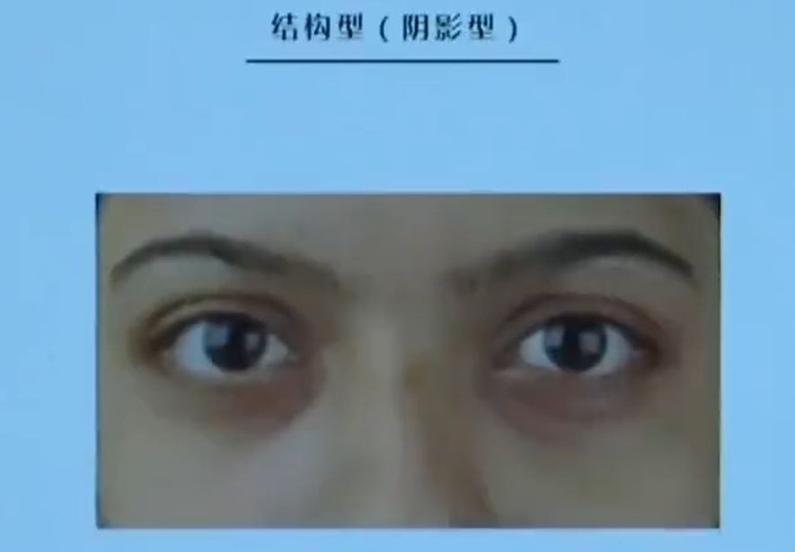 南京黑眼圈门诊开诊1年一号难求(长黑眼圈跟入睡时间有关)