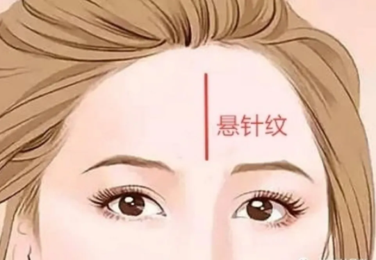 如何预防额头出现悬针纹?额头有悬针纹怎么去除好?