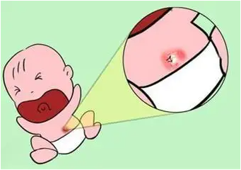 脐带囊肿生出的宝宝是正常的吗(脐带囊肿如何预防) 脐带囊肿生出的宝宝是正常的吗(脐带囊肿如何预防)