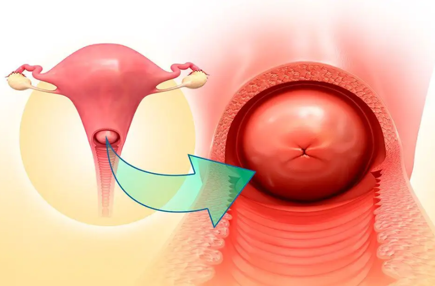 宫颈肥大女性容易月经不调吗?宫颈肥大女性经期要注意啥?