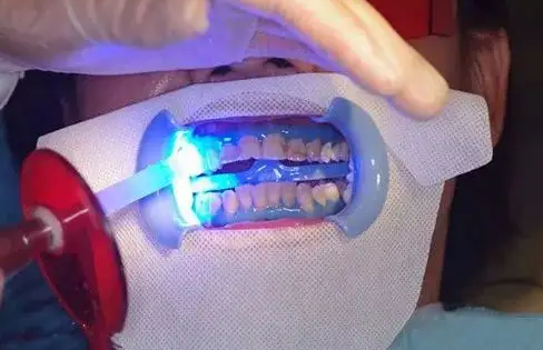牙齿美白最快的方法是什么（冷光美白牙齿副作用有哪些）