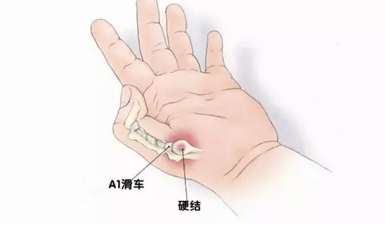大拇指关节腱鞘炎是什么原因（大拇指关节腱鞘炎该怎么治疗呢）
