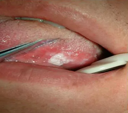 口腔黏膜白斑是什么原因造成的（口腔黏膜白斑该如何进行治疗）