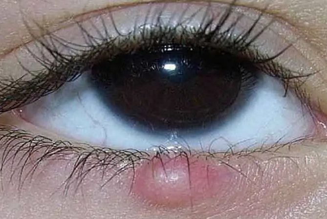 眼睛麦粒肿是什么原因（眼睛麦粒肿该如何进行治疗）