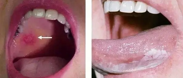 口腔黏膜白斑是什么原因造成的（口腔黏膜白斑该如何进行治疗）