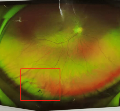 视网膜脱落的症状有哪些（视网膜脱落有什么办法治疗吗）