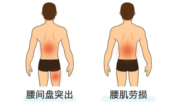 腰肌劳损的症状有哪些呢（腰肌劳损该如何进行治疗呢）