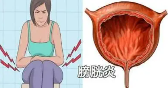 腺性膀胱炎是什么原因引起的（腺性膀胱炎该如何进行治疗呢）