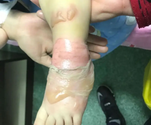 宝宝烫伤会出现什么症状(宝宝烫伤该怎么快速治疗呢)