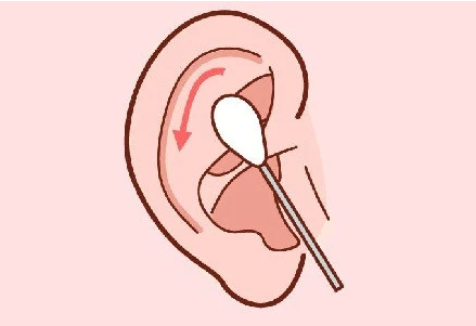 男子感冒后用力擤鼻涕引发中耳炎(感冒后该怎么擤鼻涕2026)