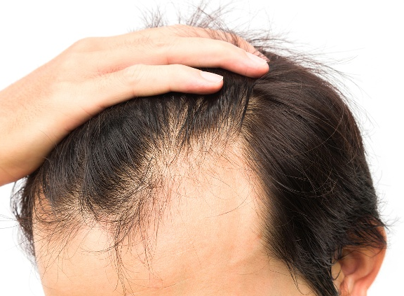 阳康后可能会脱发是咋回事(阳康后如何防止脱发)