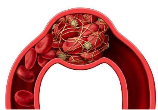 新冠为何会增加血栓风险(阳后30天出现这两种迹象可能是血栓)