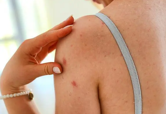 超90%的成人体内有水痘带状疱疹病毒，50岁后要注意带状疱疹风险