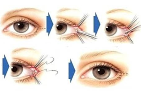 什么是眼睑下至术？真的能让眼睛变大吗？