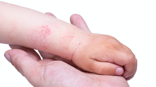 春天手部脱皮是怎么回事？小心这些皮肤疾病