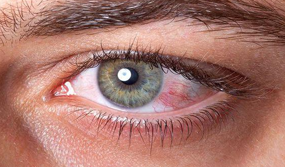 女子连戴10小时美瞳，角膜染色险失明！佩戴美瞳一定要注意的几件事