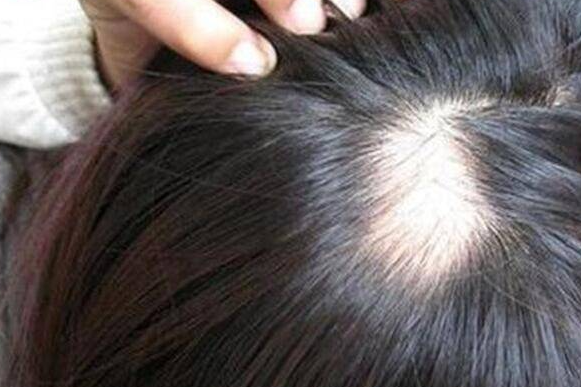 “男子一觉醒来，发现头秃了一块”，不小心得了斑秃怎么办？