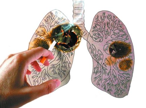 肺癌是“气”出来的病吗?哪些人是肺癌高危人群? 肺癌是“气”出来的病吗?哪些人是肺癌高危人群?