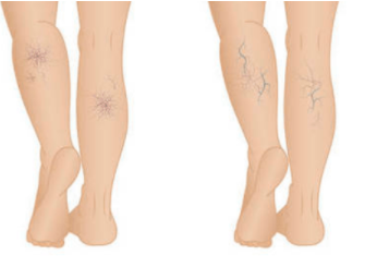 为什么静脉曲张不会自己恢复？静脉曲张可以自动消失或减轻？