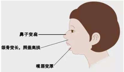 口呼吸嘴凸怎么矫正 口呼吸面容如何矫正