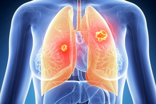 肺癌是“气”出来的病吗？哪些人是肺癌高危人群？