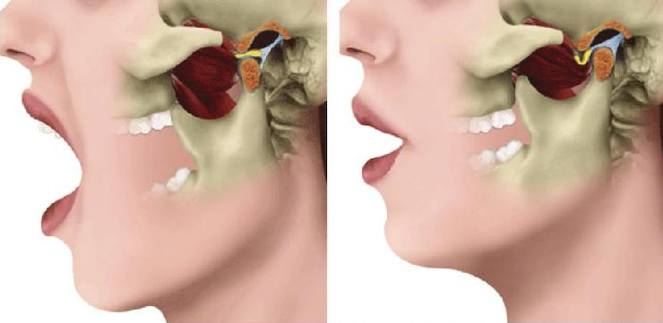 颞下颌关节紊乱怎么治?打哈欠嘴合不上是颞下颌关节紊乱吗？
