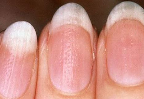 身体好不好看指甲，哪些指甲变化需要警惕疾病的风险?