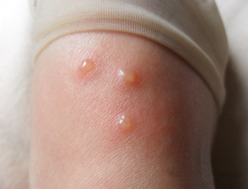 春天手上长出小水泡，是手藓还是汗疱疹？该怎么治疗？