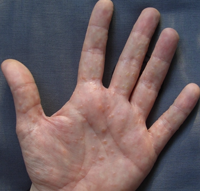 春天手上长出小水泡，是手藓还是汗疱疹？该怎么治疗？