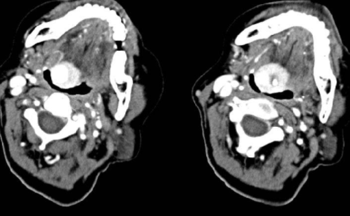 小孩子脖子鼓包怎么回事？小心是囊肿！
