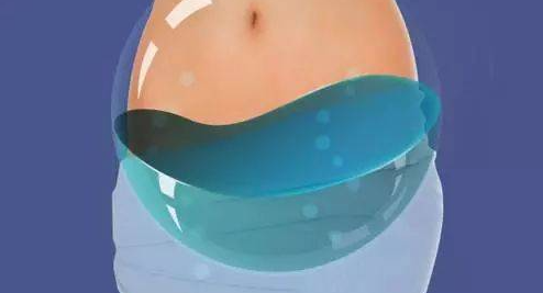 盆腔积液是什么？一定会转化成盆腔炎吗？一篇教你辨认！