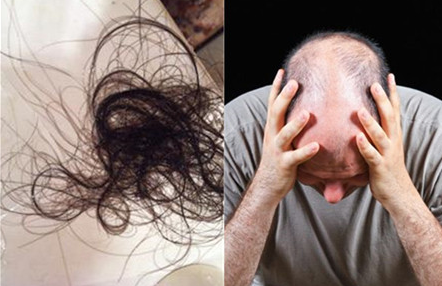 植发虽好但有后遗症？这5种影响医生打死都不会告诉你！