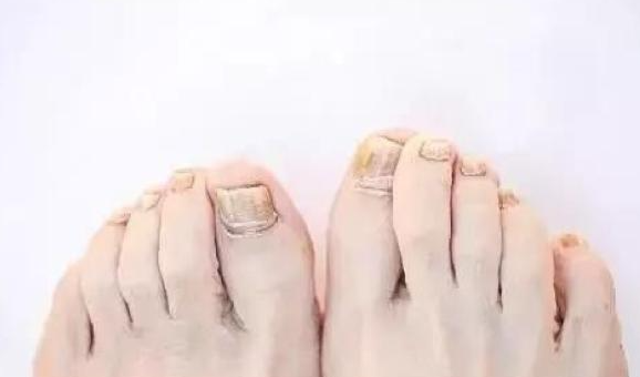 灰指甲不管会自愈吗？什么样的人容易得灰指甲？