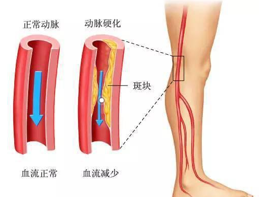 经常无缘无故的腿部疼痛抽搐，可能与血管病变有关！