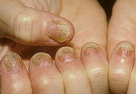 灰指甲不管会自愈吗？什么样的人容易得灰指甲？