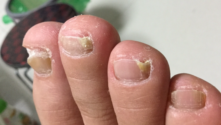 灰指甲不管会自愈吗？什么样的人容易得灰指甲？