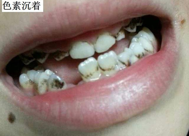小孩牙齿上的黑点是蛀牙吗？4步教你区分！